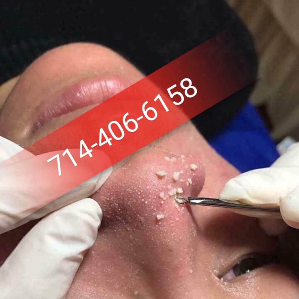 Ohio Blackheads Removed
